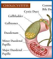 CEN Cholecystitis