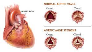 NCLEX Aortic Stenosis Review