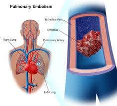 CEN Pulmonary Embolism Review