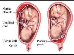 NCLEX Placenta Previa 