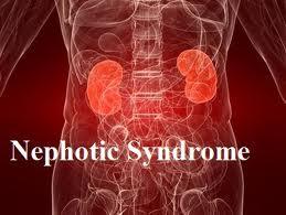 NCLEX Nephrotic Syndrome Review