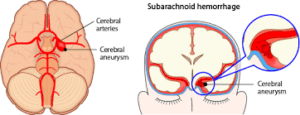 CCRN Subarachnoid Hemorrhage