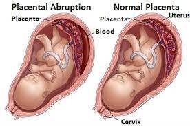 NCLEX Placenta Abruption
