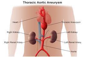 CCRN Aortic Aneurysm Review