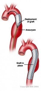 ccrn aortic aneurysm