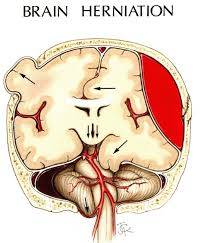 CEN Brain Herniation Review