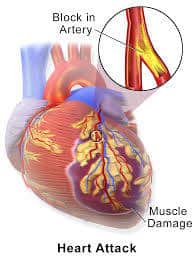 CCRN Myocardial Infarction Review
