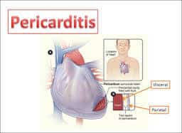 CCRN Pericarditis Review