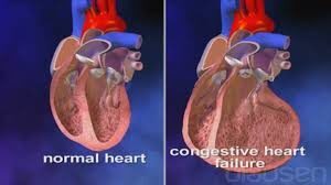 pccn congestive heart failrue