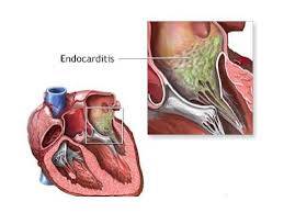 pccn endocarditis
