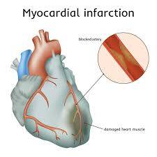 PCCN Myocardial Infarction
