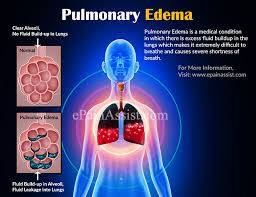 PCCN Pulmonary Edema