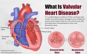 PCCN Valvular Heart Disease