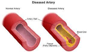 PCCN Peripheral Artery Disease