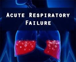 CCRN Acute Respiratory Failure Review
