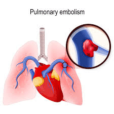 CCRN Pulmonary Embolism
