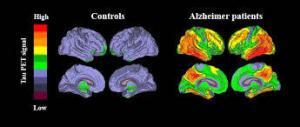 cen Alzheimers Disease