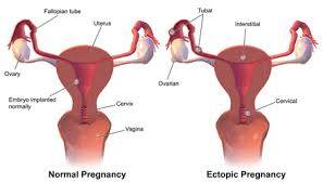 CEN Ectopic Pregnancy