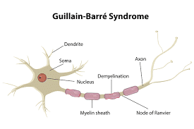 CEN Guillain Barre Syndrome