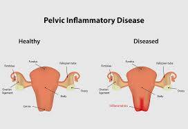 CEN Pelvic Inflammatory Disease