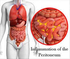 CEN Peritonitis