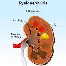 CEN Pyelonephritis