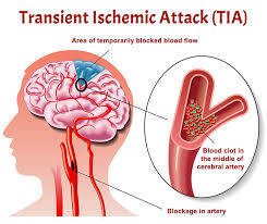 CEN Transient Ischemic Attack